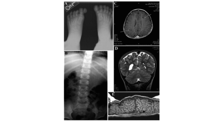 A novel syndrome of cerebral cavernous malformation and greig cephalopolysyndactyly. laboratory investigation